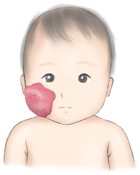 乳児血管腫の例。乳児の頬に赤い隆起性の病変がある
