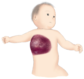 乳児血管腫以外の血管性腫瘍の例。乳児の体幹に暗赤色の病変がある