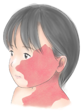 毛細血管奇形の例。顔面から頸部に広がる赤色の平坦な病変