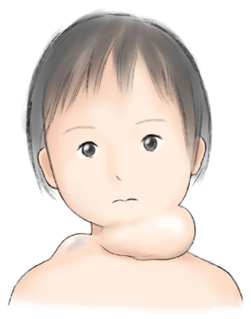 リンパ管奇形の例。乳児の頸部に膨隆した腫瘤がある