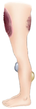 静脈奇形の例。下肢に暗赤色から青色の病変がある
