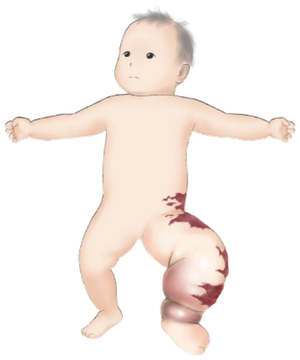 混合型脈管奇形の例。乳児の下肢に地図状の暗赤色病変と患肢の肥大がある